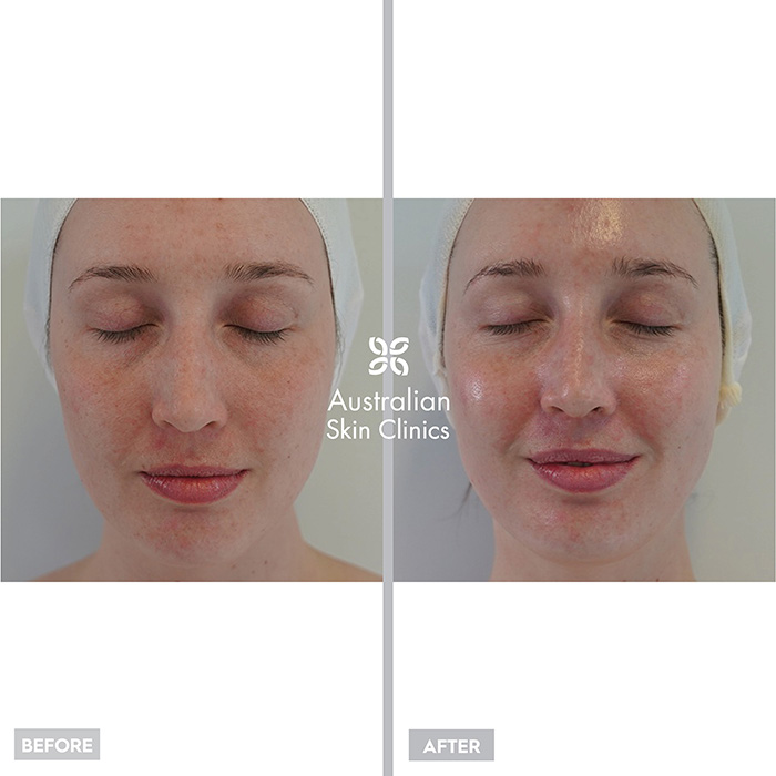 Before and After MediFacials Skin Treatment - Australian Skin Clinics