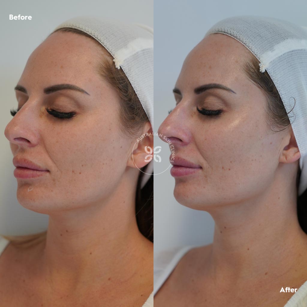 Before & After Dermaplanning Skin Treatments