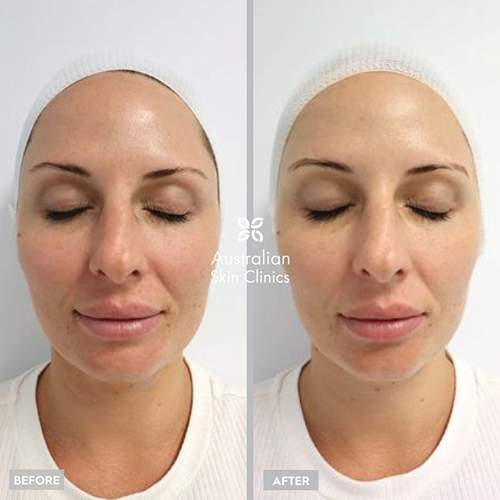 Before and After MediFacials Skin Treatment - Australian Skin Clinics