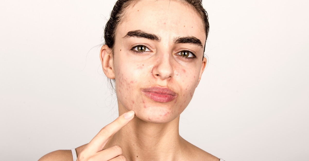 acne transformations