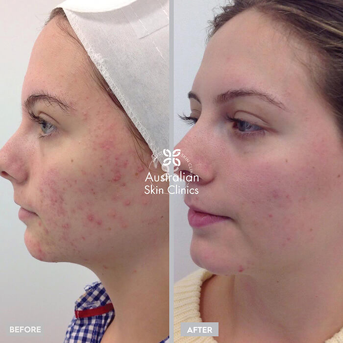 Before and After Skin Results