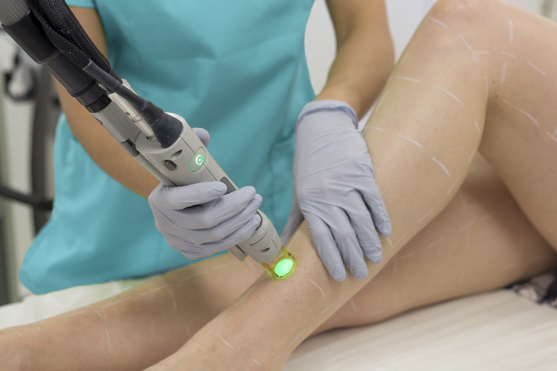 Laser Hair Removal Treatment