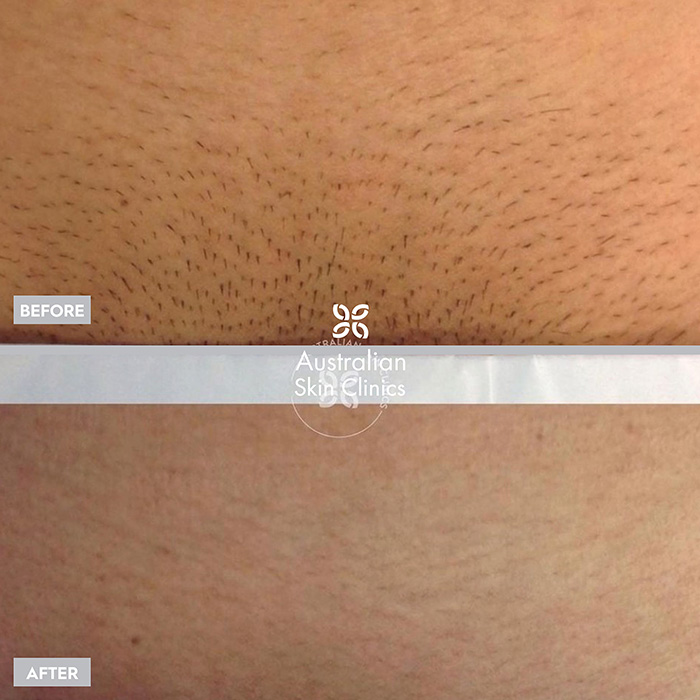 Before and After Picture of Patient After Getting a Laser Hair Removal Treatment