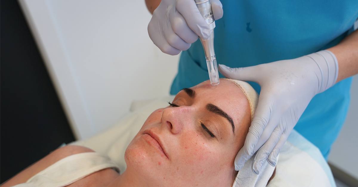 Top 5 benefits of micro-needling