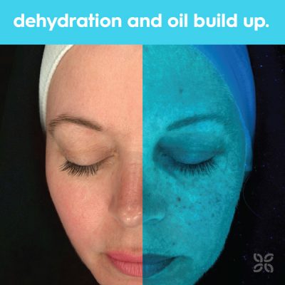 Advanced Observ 520 Skin analysis technology - Skin Clinics