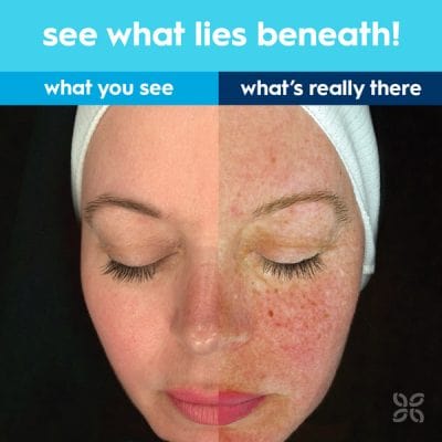 Advanced Observ 520 Skin analysis technology - Skin Clinics