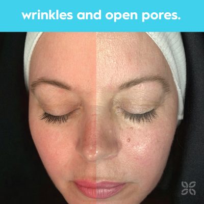 Advanced Observ 520 Skin analysis technology - Skin Clinics