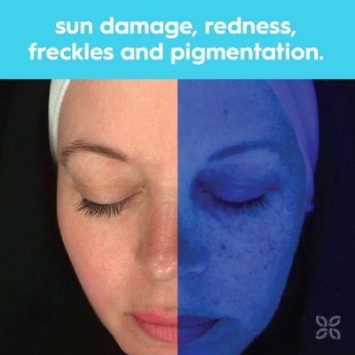 Advanced Observ 520 Skin analysis technology - Skin Clinics