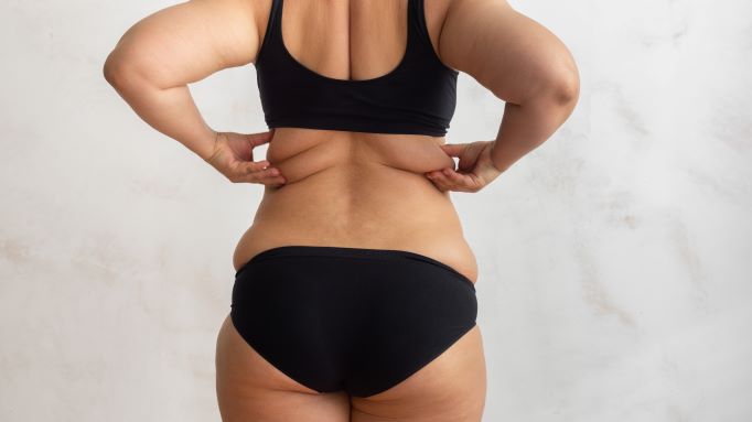 Stubborn Fat Treatment