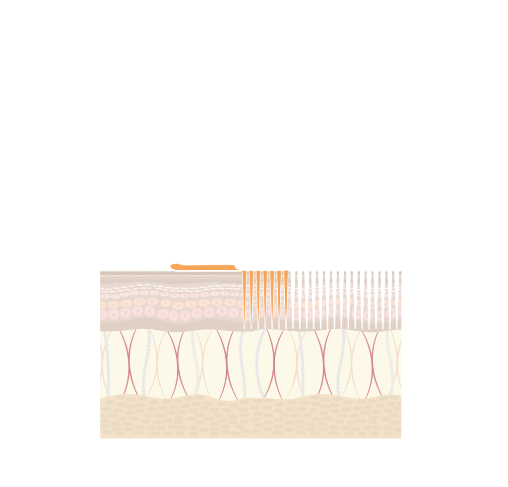 MesoInfus™ Needling How it works diagram