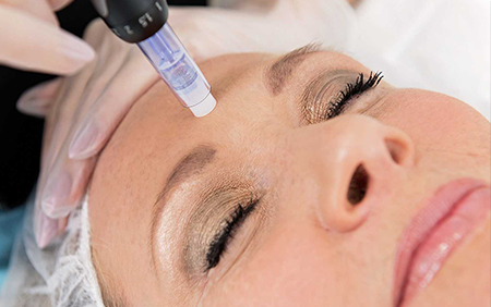 Microneedling Skin treatment